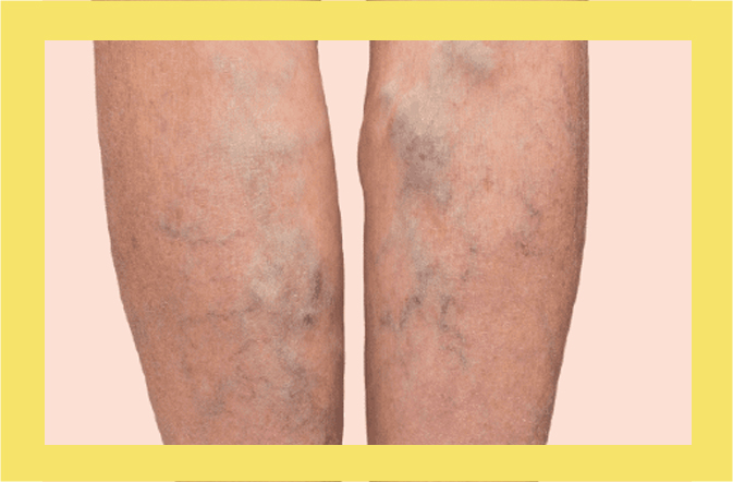Varicose Veins