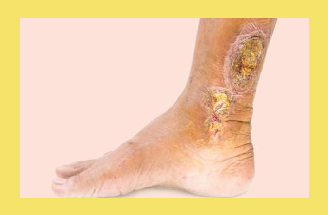 Venous Leg Ulcer